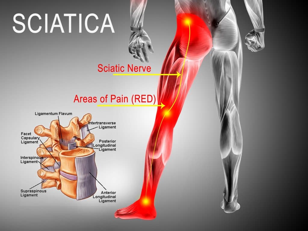 Sciatica Treatment